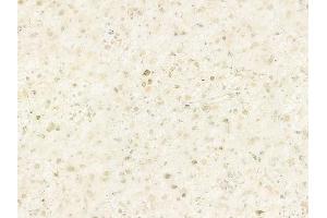 ABIN6264227 and ABIN6278772 at 1/100 staining human astrocytoma by IHC-P.