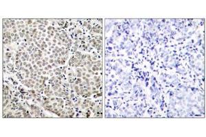 Immunohistochemical analysis of paraffin-embedded human breast carcinoma tissue, using NF-κB p65 (Phospho-Ser529) antibody (E011217). (NF-kB p65 抗体  (pSer529))