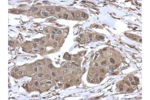 IHC-P Image Immunohistochemical analysis of paraffin-embedded human breast cancer, using VCP, antibody at 1:500 dilution. (VCP 抗体  (C-Term))
