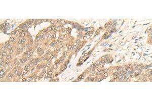 Immunohistochemistry of paraffin-embedded Human liver cancer tissue using IMPA1 Polyclonal Antibody at dilution of 1:25(x200) (IMPA1 抗体)
