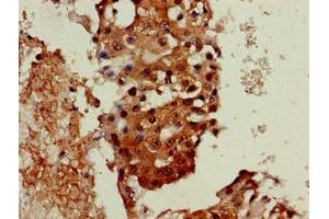 Immunohistochemistry of paraffin-embedded human breast cancer using ABIN7161445 at dilution of 1:100 (Neuroserpin 抗体  (AA 191-240))