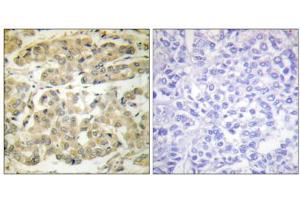 Immunohistochemical analysis of paraffin-embedded human breast carcinoma tissue, using 14-3-3 zeta (phospho-Ser58) antibody. (14-3-3 zeta 抗体  (pSer58))