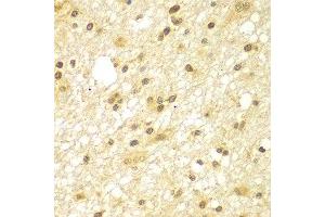 Immunohistochemistry of paraffin-embedded human brain cancer using TBL1XR1 antibody at dilution of 1:100 (x400 lens). (TBL1XR1 抗体)
