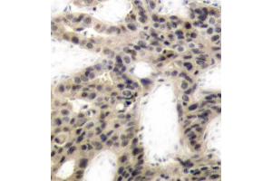 Immunohistochemistry of paraffin-embedded human breast carcinoma using Phospho-EIF4EBP1-T45 antibody (ABIN2987638). (eIF4EBP1 抗体  (pThr45))