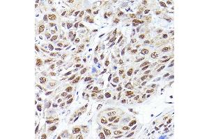 Immunohistochemistry of paraffin-embedded human esophageal cancer using SEC14L2 Rabbit pAb (ABIN6132639, ABIN6147484, ABIN6147485 and ABIN6214889) at dilution of 1:200 (40x lens). (SEC14L2 抗体  (AA 60-270))