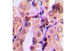 Immunohistochemical analysis of SMAD2 (pS465) staining in human breast cancer formalin fixed paraffin embedded tissue section.