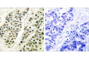 Peptide - +Immunohistochemical analysis of paraffin-embedded human breast carcinoma tissue using DNA Polymerase β antibody (#C0173). (POLB 抗体)