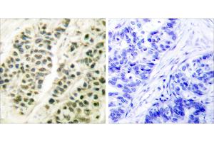 Peptide - +Immunohistochemical analysis of paraffin-embedded human breast carcinoma tissue using DNA Polymerase β antibody (#C0173).
