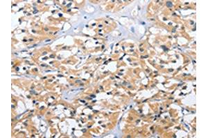 The image on the left is immunohistochemistry of paraffin-embedded Human thyroid cancer tissue using ABIN7131541(UGCG Antibody) at dilution 1/40, on the right is treated with fusion protein. (UGCG 抗体)
