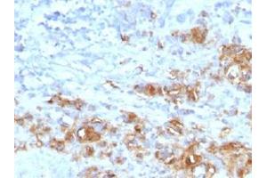Immunohistochemical staining (Formalin-fixed paraffin-embedded sections) of human gastric carcinoma with CA19-9 recombinant monoclonal antibody, clone CA19. (Recombinant CA 19-9 抗体)