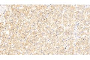 Detection of IGSF1 in Human Liver cancer Tissue using Polyclonal Antibody to Immunoglobulin superfamily, member 1 (IGSF1) (IGSF1 抗体  (AA 1008-1227))