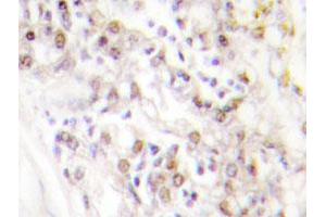 Immunohistochemical analysis of paraffin-embedded human breast cancer tissue using KIF20A polyclonal antibody . (KIF20A 抗体)