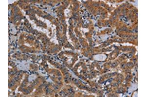The image on the left is immunohistochemistry of paraffin-embedded Human thyroid cancer tissue using ABIN7130015(KLK13 Antibody) at dilution 1/20, on the right is treated with fusion protein. (Kallikrein 13 抗体)