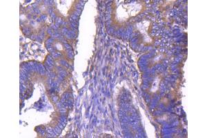 Paraformaldehyde-fixed, paraffin embedded human colon cancer, Antigen retrieval by boiling in sodium citrate buffer (pH6) for 15min, Block endogenous peroxidase by 3% hydrogen peroxide for 30 minutes, Blocking buffer at 37°C for 20min, Antibody incubation with ARF1 (1D4) Monoclonal Antibody  at 1:50 overnight at 4°C, followed by a conjugated secondary and DAB staining. (ARF1 抗体)