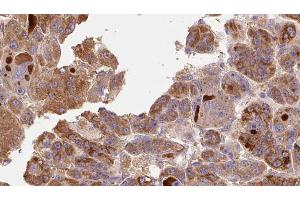 ABIN6273772 at 1/100 staining Human liver cancer tissue by IHC-P. (RIPK1 抗体  (Internal Region))