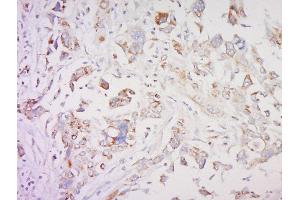 Formalin-fixed and paraffin embedded human breast cancer labeled with SMAD1 Polyclonal Antibody, Unconjugated  at 1:200 followed by conjugation to the secondary antibody and DAB staining (SMAD1 抗体  (AA 151-250))