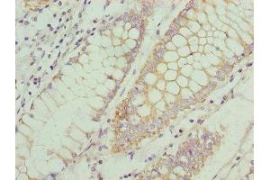 Immunohistochemistry of paraffin-embedded human colon cancer using ABIN7145914 at dilution of 1:100 (CCR1 抗体  (AA 306-355))