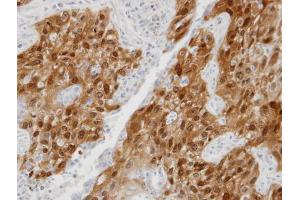IHC-P Image Immunohistochemical analysis of paraffin-embedded lung SCC xenograft, using DDX5, antibody at 1:100 dilution. (DDX5 抗体  (C-Term))