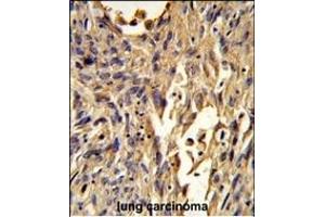 Formalin-fixed and paraffin-embedded human lung carcinoma reacted with S100A10 Antibody (Center), which was peroxidase-conjugated to the secondary antibody, followed by DAB staining. (S100A10 抗体  (AA 12-40))