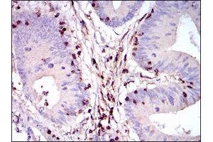Immunohistochemical analysis of paraffin-embedded colon cancer tissues using PTPRC mouse mAb with DAB staining. (CD45 抗体  (AA 928-989))