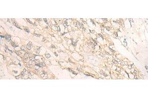 Immunohistochemistry of paraffin-embedded Human gastric cancer tissue using DMTN Polyclonal Antibody at dilution of 1:35(x200) (Dematin 抗体)