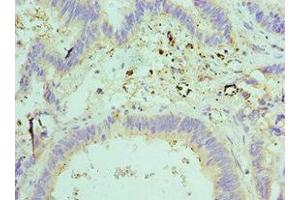 Immunohistochemistry of paraffin-embedded human colon cancer using ABIN7151593 at dilution of 1:100