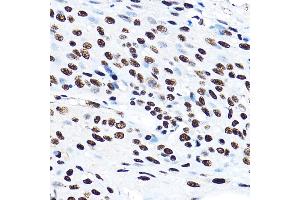 Immunohistochemistry of paraffin-embedded human esophageal cancer using SF3 Rabbit pAb (ABIN1682671, ABIN3018959, ABIN3018960 and ABIN6220644) at dilution of 1:100 (40x lens). (SF3A3 抗体  (AA 292-501))