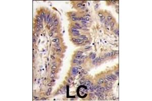 Formalin-fixed and paraffin-embedded human lung carcinoma tissue reacted with *TGM2 antibody (Center ), which was peroxidase-conjugated to the secondary antibody, followed by DAB staining. (Transglutaminase 2 抗体  (AA 429-458))