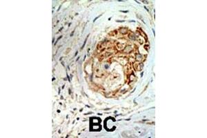 Formalin-fixed and paraffin-embedded human cancer tissue reacted with the primary antibody, which was peroxidase-conjugated to the secondary antibody, followed by DAB staining. (MBD3 抗体  (C-Term))