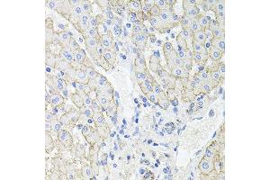 Immunohistochemistry of paraffin-embedded human liver injury using ATP1B1 antibody at dilution of 1:100 (x40 lens).