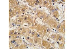 IHC analysis of FFPE human hepatocarcinoma tissue stained with APOA5 antibody (APOA5 抗体  (AA 22-52))