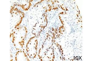 IHC staining of human lung adenocarcinoma (10X) with TTF-1 antibody (8G7G3/1). (TTF1 抗体)