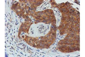Immunohistochemical staining of paraffin-embedded Carcinoma of Human lung tissue using anti-TULP3 mouse monoclonal antibody. (TULP3 抗体)