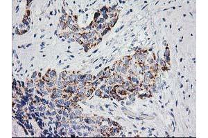 Immunohistochemical staining of paraffin-embedded Adenocarcinoma of Human breast tissue using anti-PPM1B mouse monoclonal antibody. (PPM1B 抗体)