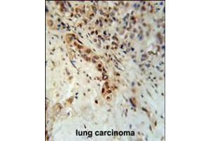 DCLRE1C Antibody immunohistochemistry analysis in formalin fixed and paraffin embedded human lung carcinoma followed by peroxidase conjugation of the secondary antibody and DAB staining. (DCLRE1C 抗体  (N-Term))