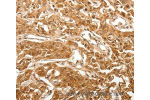 Immunohistochemistry of Human lung cancer using TXN Polyclonal Antibody at dilution of 1:40 (TXN 抗体)