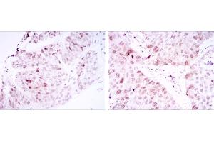 Immunohistochemical analysis of paraffin-embedded ovarian cancer tissues (left) and lung cancer tissues (right) using CDK1 mouse mAb with DAB staining. (CDK1 抗体)