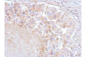 IHC-P Image Annexin VI antibody [C2C3], C-term detects ANXA6 protein at cytosol on human breast by immunohistochemical analysis. (ANXA6 抗体  (C-Term))