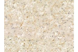 ABIN6264173 and ABIN6273295 at 1/100 staining human astrocytoma by IHC-P.