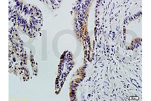 Formalin-fixed and paraffin-embedded : human colon carcinoma labeled with Rabbit Anti-Integrin ? (ITGAV/ITGB1 抗体)