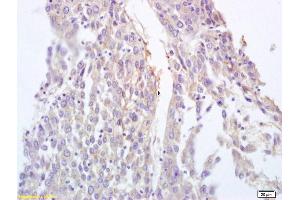 Formalin-fixed and paraffin embedded human lung carcinoma labeled with Anti-BRLF1 Polyclonal Antibody, Unconjugated (ABIN873254) at 1:200 followed by conjugation to the secondary antibody and DAB staining. (Protein Rta/BRLF1 抗体  (AA 81-180))