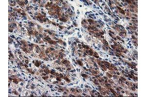 Immunohistochemical staining of paraffin-embedded Carcinoma of Human liver tissue using anti-SEC14L2 mouse monoclonal antibody. (SEC14L2 抗体)