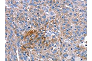 The image on the left is immunohistochemistry of paraffin-embedded Human breast cancer tissue using ABIN7192628(SPATA5L1 Antibody) at dilution 1/20, on the right is treated with synthetic peptide. (SPATA5L1 抗体)