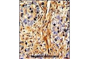 Formalin-fixed and paraffin-embedded human hepatocarcinoma with LB2 Antibody (C-term), which was peroxidase-conjugated to the secondary antibody, followed by DAB staining. (LAMB2 抗体  (C-Term))