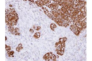 IHC-P Image Immunohistochemical analysis of paraffin-embedded SW480 xenograft , using alpha Glucosidase II, antibody at 1:500 dilution. (GANAB 抗体  (N-Term))