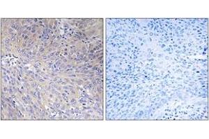Immunohistochemistry analysis of paraffin-embedded human cervix carcinoma tissue, using MRPL11 Antibody. (MRPL11 抗体  (AA 21-70))