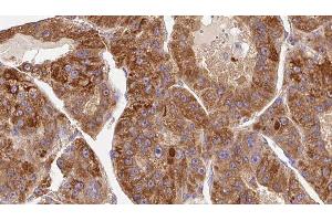 ABIN6276768 at 1/100 staining Human liver cancer tissue by IHC-P. (KIR3DL1 抗体  (Internal Region))