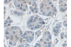 Detection of ERK1 in Human Pancreatic cancer Tissue using Polyclonal Antibody to Extracellular Signal Regulated Kinase 1 (ERK1) (ERK1 抗体  (AA 75-312))
