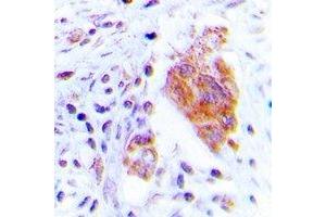 Immunohistochemical analysis of CDC37 (pS13) staining in human lung cancer formalin fixed paraffin embedded tissue section. (CDC37 抗体  (N-Term, pSer13))