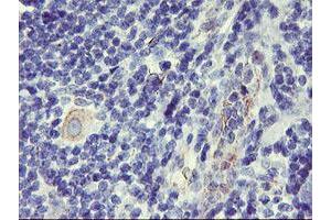 Immunohistochemical staining of paraffin-embedded Human lymphoma tissue using anti-DPP9 mouse monoclonal antibody. (DPP9 抗体)